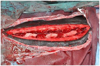 Use of wound infusion catheters for delivery of local anesthetic following standing partial ostectomy of thoracolumbar vertebral spinous processes in horses is not associated with increased surgical site infections